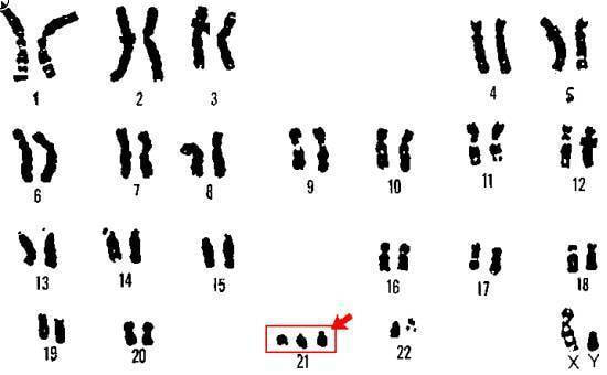 Trisomie 21